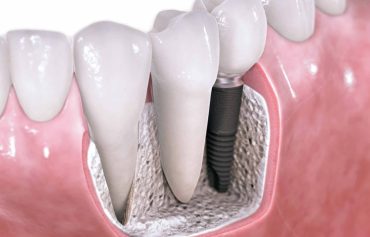 Dental Implants